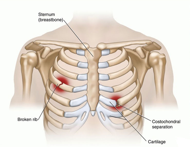 Gãy xương sườn - Hình ảnh minh họa